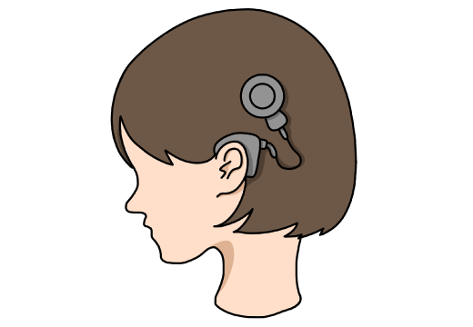 人工内耳とは